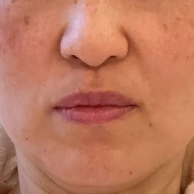 施術結果１の術後