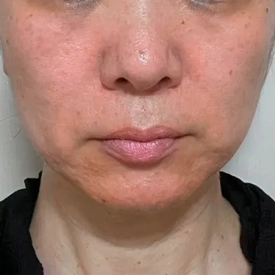 施術結果２の術後