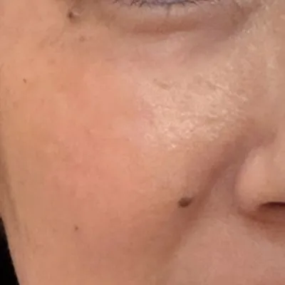 施術結果３の術後