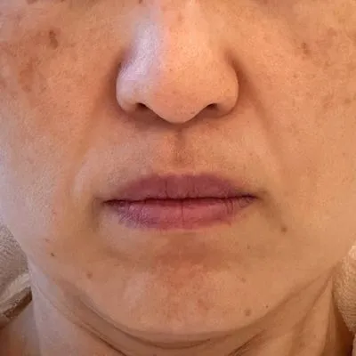 施術結果１の術前