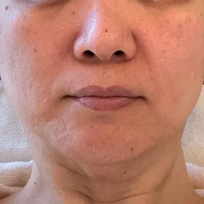 施術結果２の術前