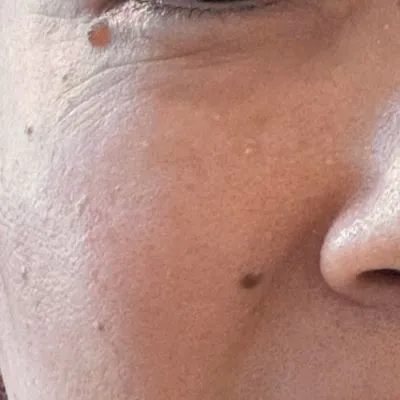 施術結果３の術前